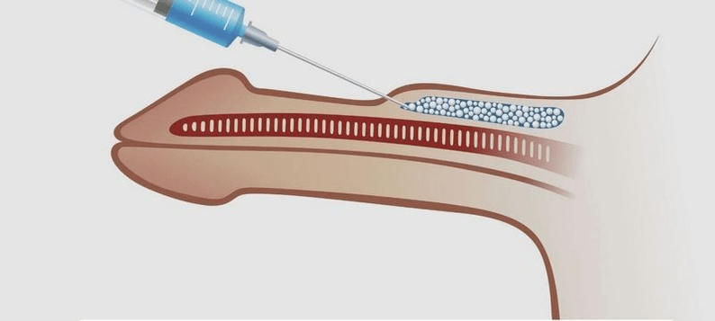 penis injection